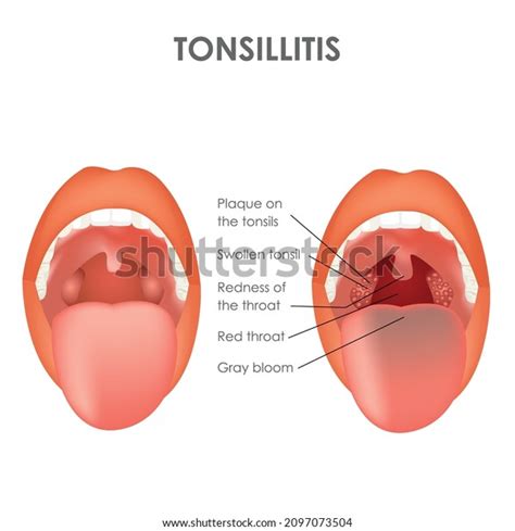 Tonsillitis Norm Disease Throat Structure Vector Stock Vector Royalty