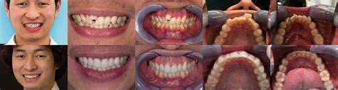 Is Invisalign Good For Crooked Teeth Teethwalls