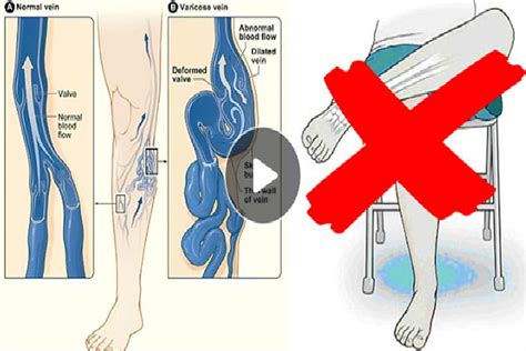 Dangers That You Can Get From Crossing Your Legs While Sitting Shocking Non Stop Healthy