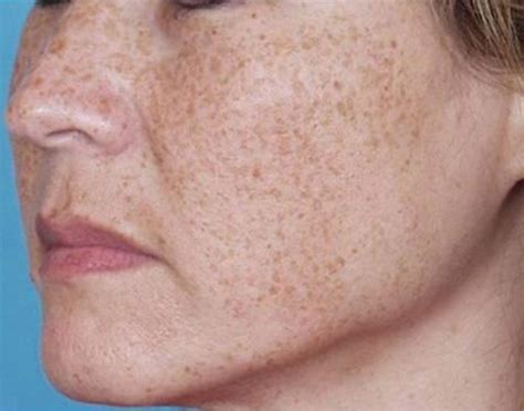 Everything Youve Ever Wanted To Know About Brown Spots
