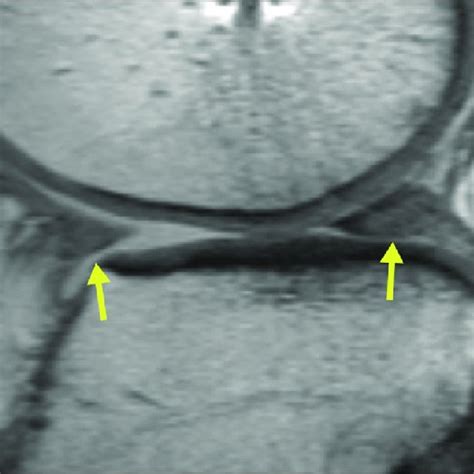 Sagittal T1 Weighted Fast Spin Echo Mr Image Of A Lateral Meniscal