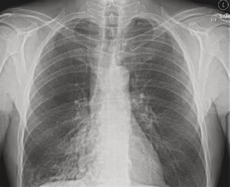 Cureus A Case Of Occult Pistachio Shell Endobronchial Foreign Body