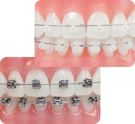 Orthodontic Braces Treatment Perfect Smile Dental Centre