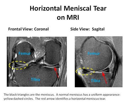 Meniscus Anatomy Mri