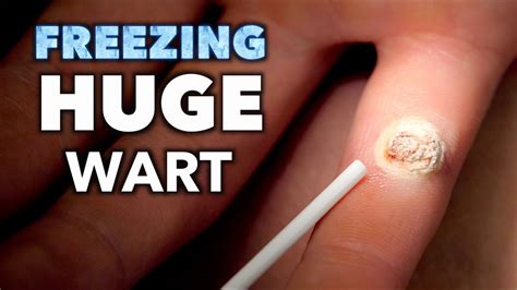freezing a huge infected wart with liquid nitrogen dr paul youtube