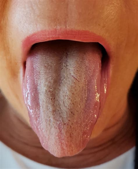 Tongue Diagnosis