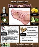 Home Remedies Corn Removal Images