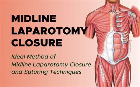 Continuous Midline Laparotomy Closure Suture Techniques Gynecoloncol