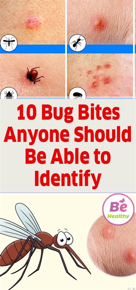 Insect Bite Identification Chart Symptoms