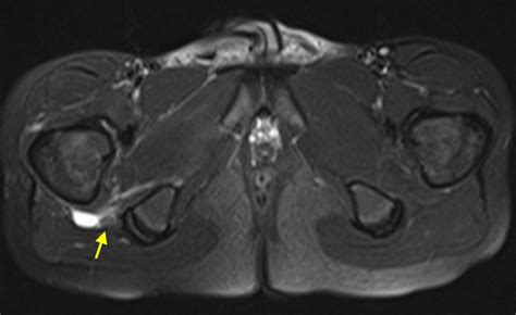 Sciatic Nerve Palsy Complicating Posterior Hip Dislocation In A Child