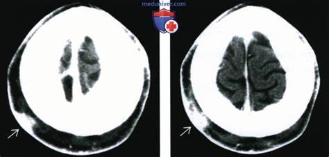 Рентгенограмма, КТ, МРТ, УЗИ при саркоме Капоши Картинка - Рентгенограмма, КТ, МРТ, УЗИ при саркоме Капоши