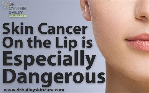 Skin Cancer On The Lip Can Be Avoided With These Dermatologists Tips