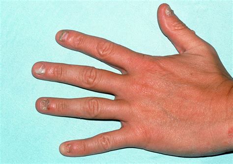View Of Hand With Fungal Nail Infection Tinea Photograph By Science