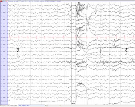 Benign Childhood Epilepsy With Centrotemporal Spikes Bects Or