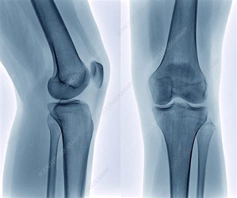 Knee Replacement X Ray Stock Image M Science Photo Library My XXX Hot