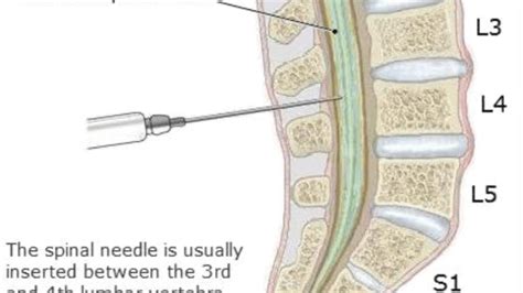 Lumbar Puncture Is Used To Diagnose And Treat Certain Leukemias And