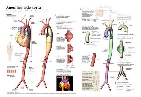 Aneurisma Aorta By Quiero Salud Issuu