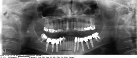 Nerve Repositioning For Lower Dental Implants