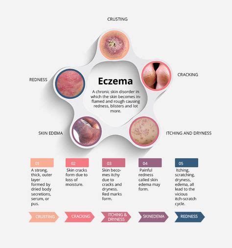 174 Best Atopic Dermatitis Eczema Images In 2019 Natural Home