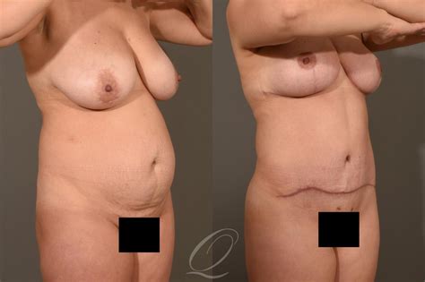 Breast Lift Before After Photos Patient 395 Serving Rochester