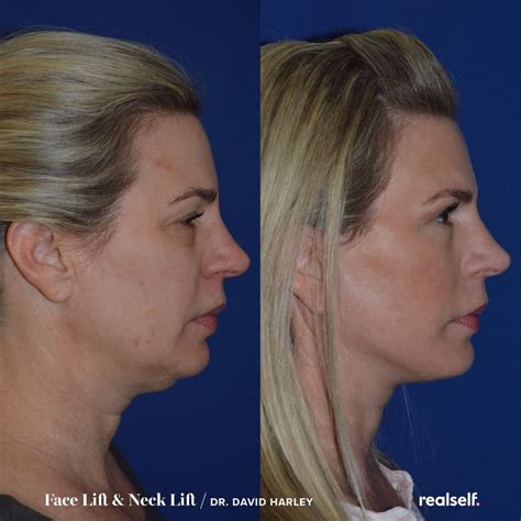 10 Things To Know Before Getting A Facelift Face Lift Surgery Neck
