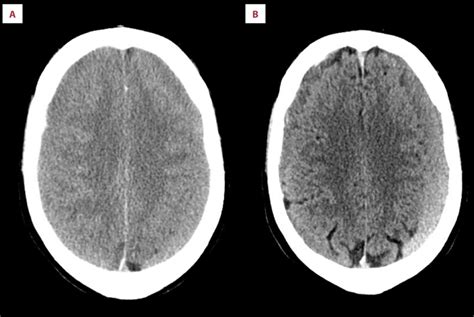 Computed Tomography Ct Scan Of Bilateral Chronic Subdural Hematoma My