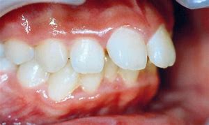 出っ歯 に対する画像結果