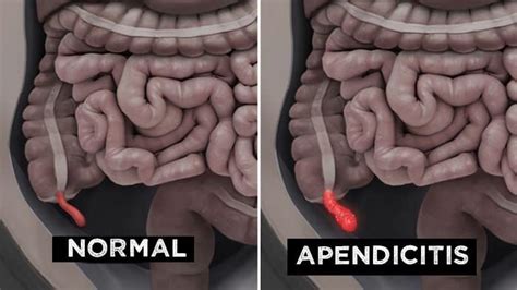 Porqué da la apendicitis síntomas y como se trata