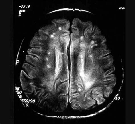 Brain Mri Flair Showing White Matter Hyperintense Lesions In A
