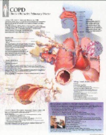 Secrets Of Buying COPD Chart Laminated Wall Chart Pulmonary And