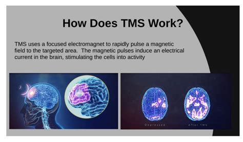 Transcranial Magnetic Stimulation Tms Therapy Wonder Years