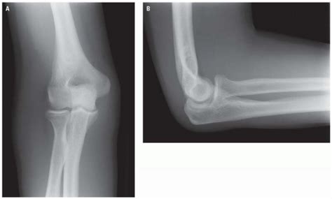 Elbow Radiology Key