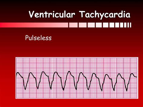 Ventricular Fibrillation And Pulseless Ventricular Tachycardia Guide