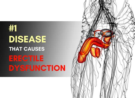1 Disease That Causes Erectile Dysfunction Dr Sam Robbins