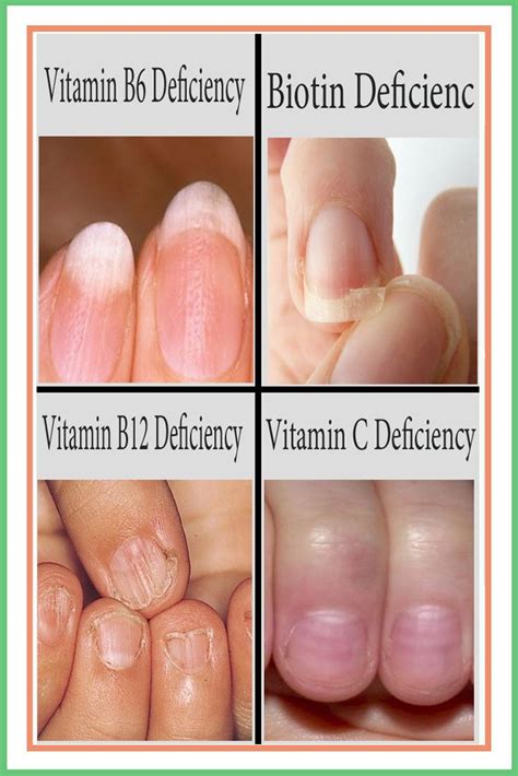 What Vitamin Deficiency Causes Vertical Ridges In Fingernails