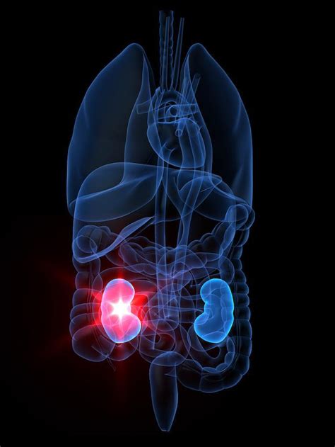 All About Kidney Cancer Risk Factors Warning Signs Diagnosis And