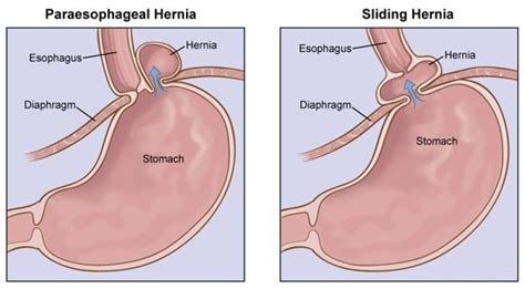 Hiatus Hernia Info Hiatus Hernias Will Cause And Risks