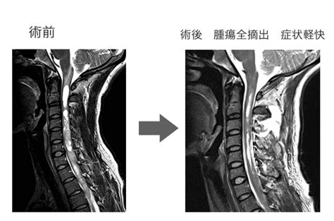 Look up in linguee suggest as a translation of 脊髄 脊髄腫瘍 - 脳神経外科教室 京都大学医学部附属病院