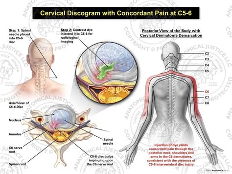 Female Right Cervical Discogram With Concordant Pain At C5 6