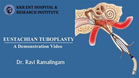 Eustachian Tuboplasty Eustachian Tube Dysfunction I Ear Block I