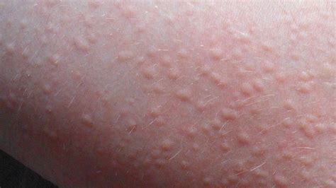 Cholinergic Urticaria Symptoms Treatment And Causes