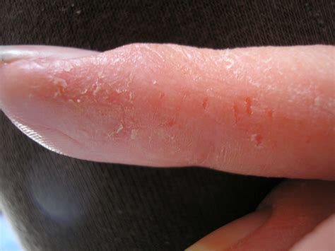 What Is Dyshidrotic Eczema Blisters On Fingers Hands