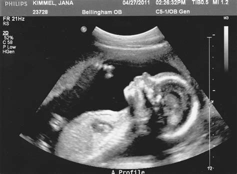 Keeping Up With The Kimmels 20 Week Ultrasound Pictures