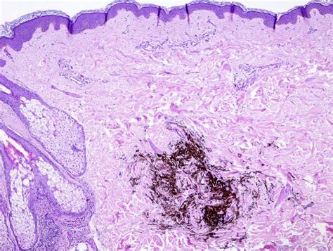 Pathology Outlines Common Blue Nevus