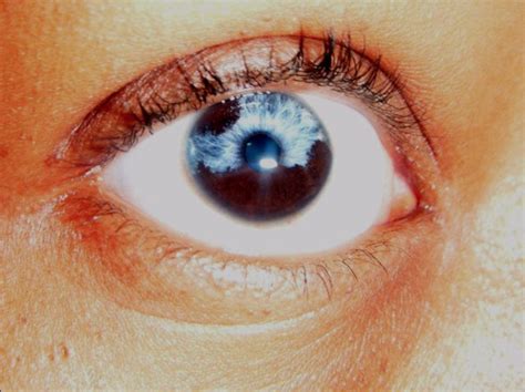 Partialsectoral Heterochromia Part Of One Iris Is A Different Color From Its Remainder