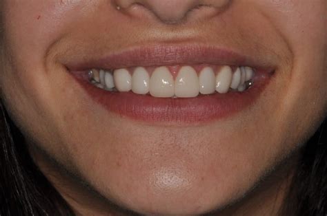 27 Pictures Of Dental Implants Amazing Before And After Photos