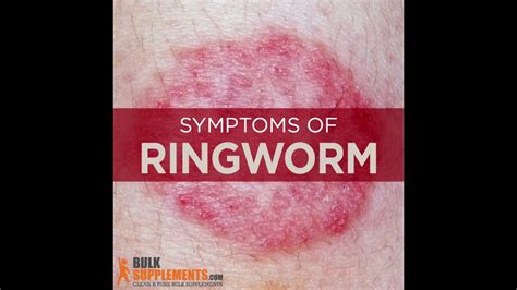 How Do You Get Ringworm How Do You Get Rid Of Ringworm Youtube