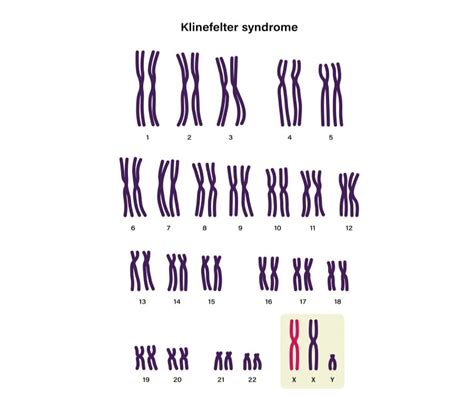 sindrome di klinefelter cause sintomi e trattamento