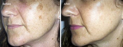 Ipl Skin Rejuvenation Benefits Efficacy Side Effects And Cost