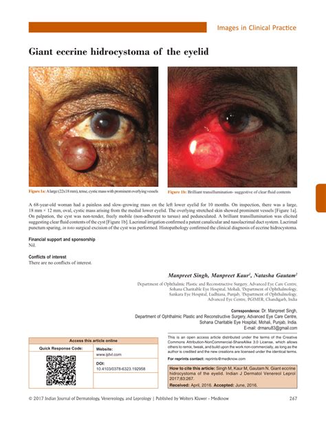 Pdf Giant Eccrine Hidrocystoma Of The Eyelid